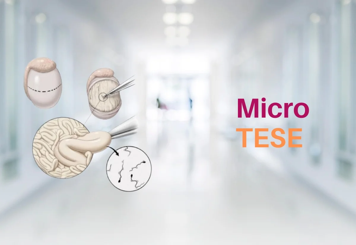Micro-TESE